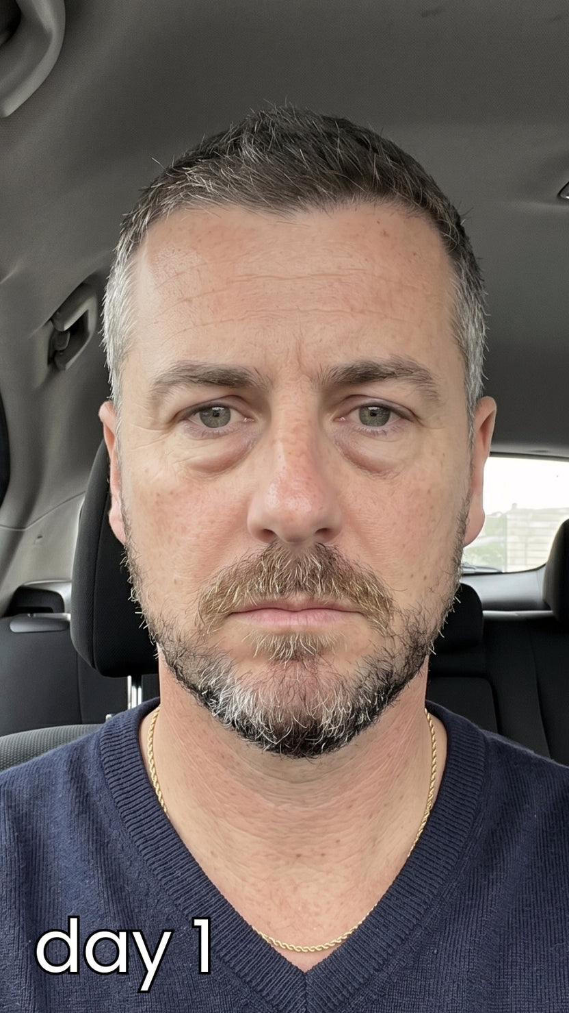 Before using RedGlow Eye Pro — under-eye puffiness and dark circles
